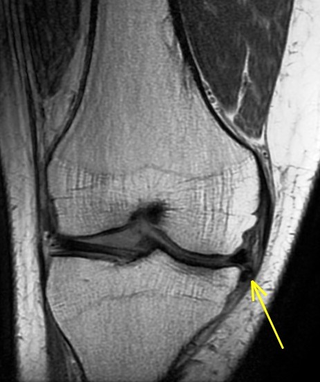 Figure 3 for case Unstable displaced medial meniscus flap tear ( RID2775 )